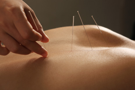 acupuncture therarpy in action